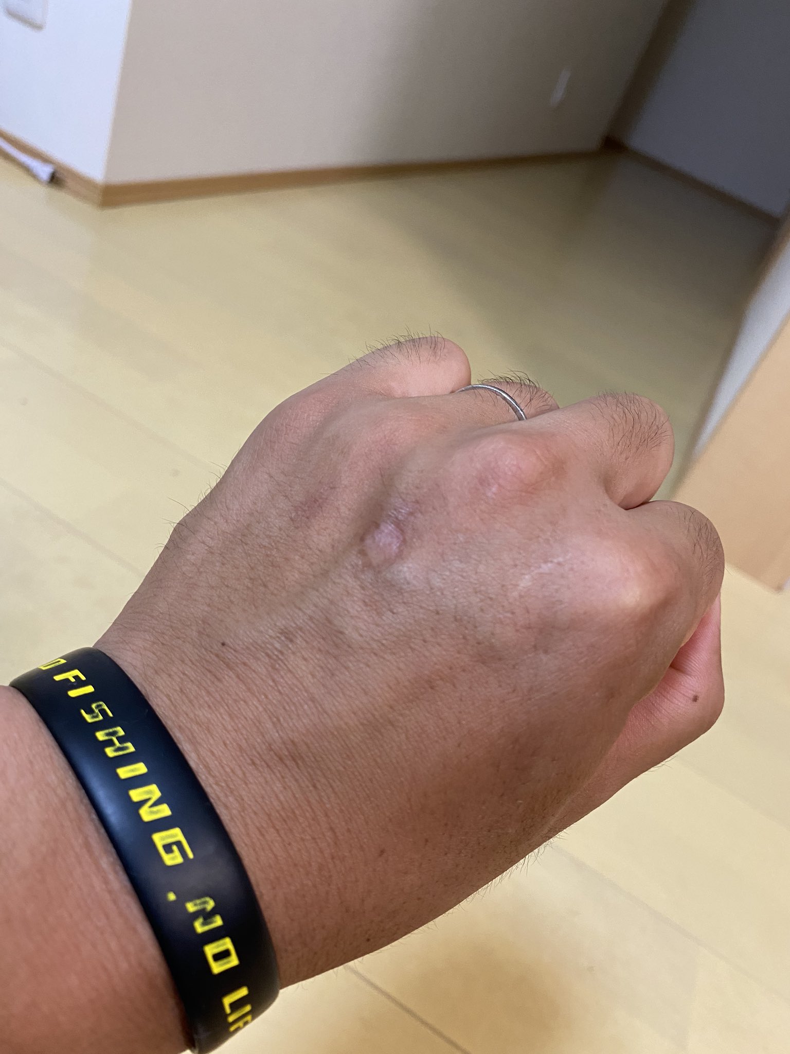 一宮安幸 グッ 古傷が痛む 左手甲の傷は小学生の頃 泳ぎながらタコを捕まえた際に噛まれ 化膿した痕です 根性焼きとよく間違われます T Co E0z7vt1glq Twitter