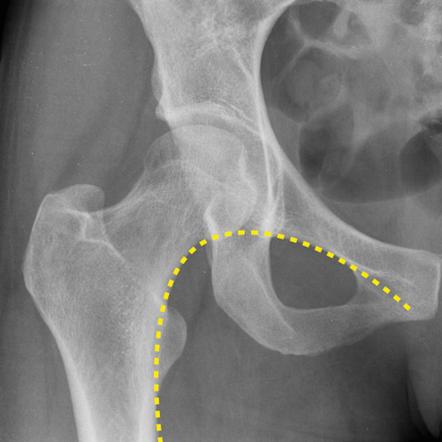 Any fracture of the femur within 5cm of the lesser trochanter is considered a NOF fracture. Some fractures may be obvious but others are not, looking at Shenton’s line can help! This should be a smooth line – if it’s not there may be a fracture!!