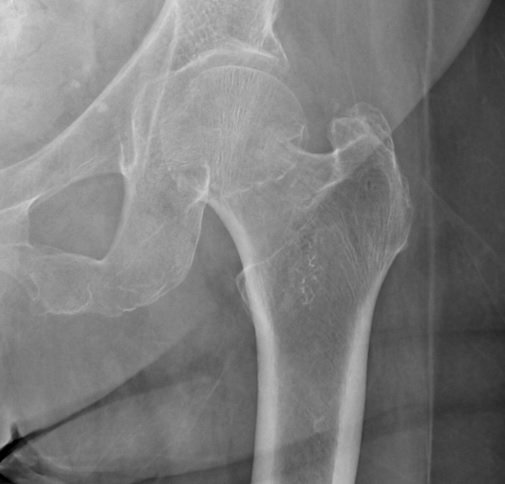 Some impacted fractures may not disrupt Shenton’s line but they may show a dense sclerotic line. And don’t forget to look out for other cause of the patients symptoms such as pubic rami or acetabular fracture!