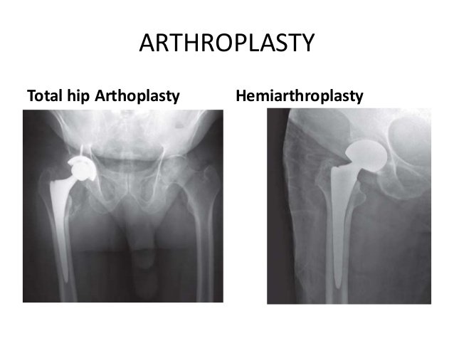 You may remember from our scaphoid fracture  #Tweetorial that this can put the proximal segment at risk of avascular necrosis if there is a displaced intracpsular fracture. They may be managed with a hemiarthroplasty or a total if the patient was very active before injury.