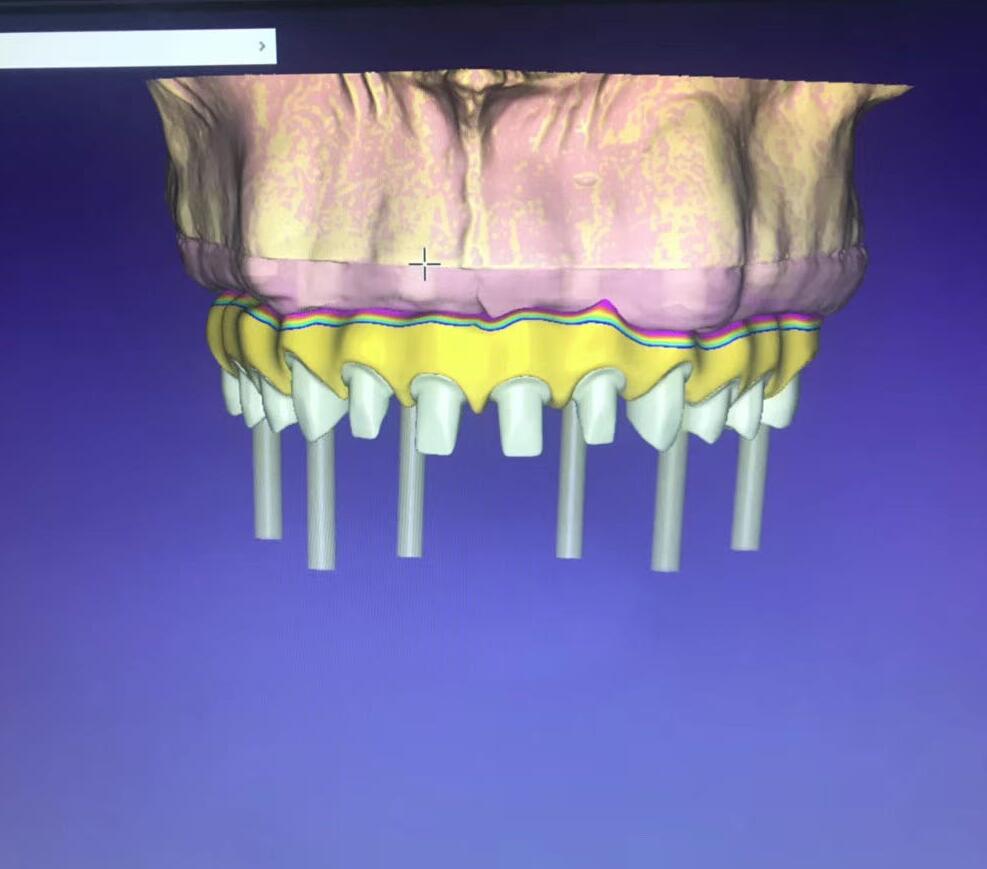 FullService_CDL's tweet photo. #Digital #dental #dentistry #crowns #clearaligners #allon4 #dds #zirconia #implant
Reducing shipping time, Saving-cost for you, just 48 hours after received files, Zirconia only 24 hours.
We have Professional team, Reliable quality, look forwards your inquiry. https://t.co/epxEk2w22T