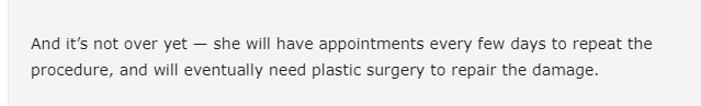 And then she says she'll need plastic surgery to repair the damage? If you actually look at her face, she's fine and it's nothing significant. I didn't need surgery for mine and I healed up. Eventually the dark scarring from my burn went away after 6 months.