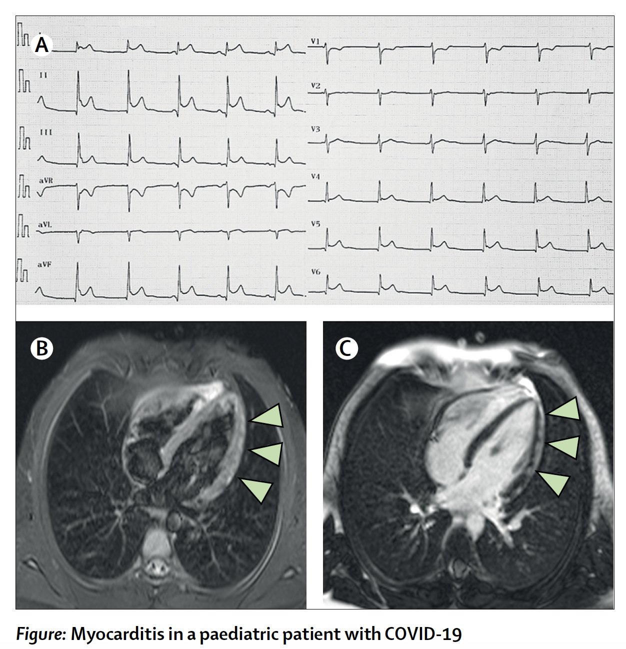 Eric Topol on Twitter "Some young athletes have been found to have heart covid involvement