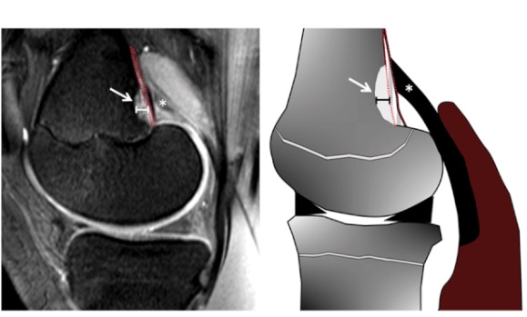 Reto Sutter (@sutterbalgrist) on Twitter photo Our #SportsImaging article was selected as <a href="/radiology_rsna/">Radiology</a> Editor’s Choice: It’s available for free pubs.rsna.org/doi/10.1148/ra…
Distal Femoral Cortical Irregularity #Knee #Skiing Check it out and feel free to share #MSKrad <a href="/derbalgrist/">Balgrist University Hospital</a> <a href="/UZH_Science/">UZH Science</a> #ESSR2020 Our #SportsImaging article was selected as <a href="/radiology_rsna/">Radiology</a> Editor’s Choice: It’s available for free pubs.rsna.org/doi/10.1148/ra…
Distal Femoral Cortical Irregularity #Knee #Skiing Check it out and feel free to share #MSKrad <a href="/derbalgrist/">Balgrist University Hospital</a> <a href="/UZH_Science/">UZH Science</a> #ESSR2020