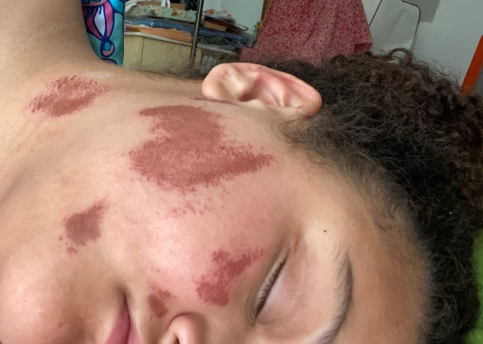 She submitted a picture and some things sticks out. Her hair is fine and she still has eyebrows and eyelashes. Which if her face were on fire, they would have been singed.