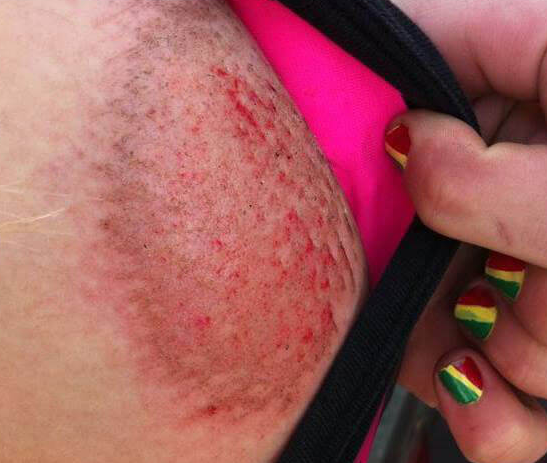 What she appears to have is some kind of road rash or eczema but not 2nd or 3rd degree burn. Go google "Road Rash Injury" and it is very similar to what she has. For example:
