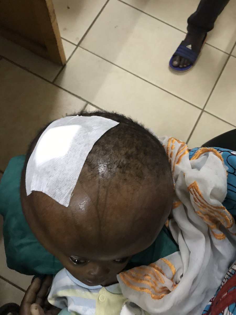 Update 1 cas du petit Oumar Sidibe, à ce jour les premiers bilans et scaner ont étés réalisés. L’opération est prévue pour jeudi In Shaa Allah. Nous sommes a 314$ sur les 1120$ continuez a soutenir on y arrivera In Shaa Allah 
OM : 90 09 09 10 
 PayPal : paypal.me/elmaoloud
