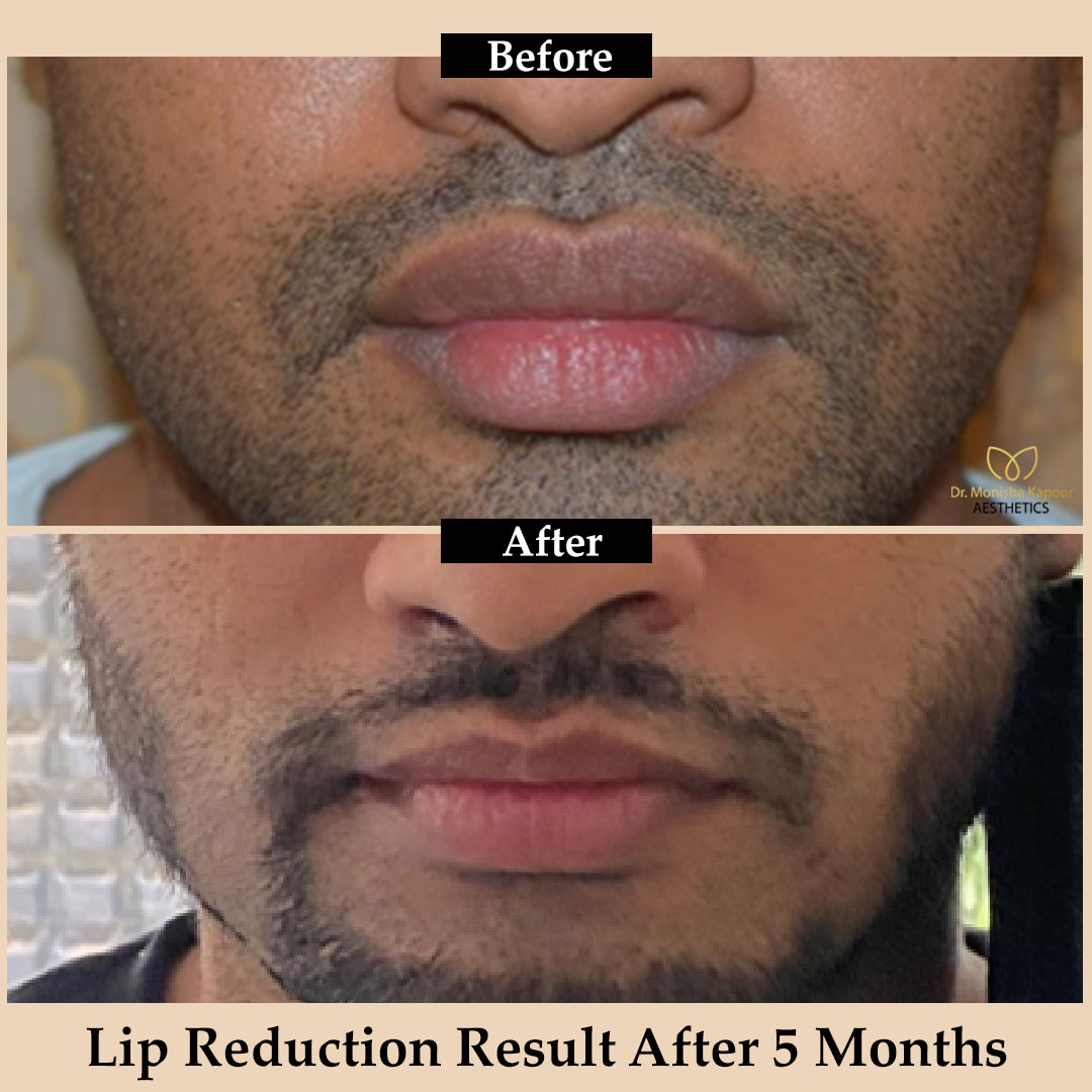 aestheticsdelhi's tweet photo. We offer natural-looking and permanent Lip Reduction. It helps in reducing the lip size, which occurs due to oversized lips, over inflammation or due to unbalanced approach.
#lipreduction #lipreductionsurgery #lipshappen #lipshape #lipreshaping #lipsurgery #lipsize #lipaesthetic https://t.co/DZSQto5q5j