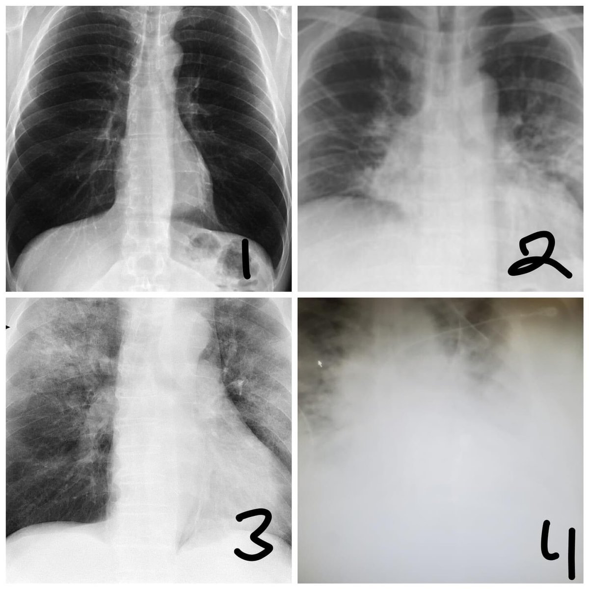 bumra's tweet photo. Chest x-rays received from a US dr. Friend .
1. Normal
2. Influenza
3. Pneumonia
4. Covid 19 https://t.co/cho5amOouP