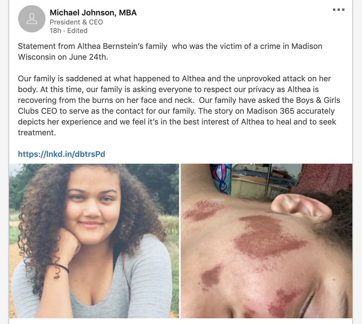 ajplus's tweet image. A Black 18yo woman was doused with lighter fluid at a stop light in Wisconsin, called the n-word and set on fire.

Althea Bernstein, reportedly an EMT, has burns to her face and neck. Police are investigating it as a hate crime and looking for 4 white men, the alleged attackers.