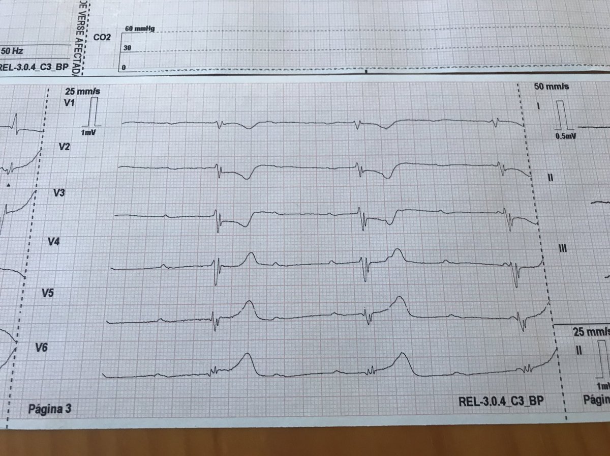 montsegorchsm's tweet photo. #primari #dolortoràcic #superatstotselsobstaclesperarribaralhospital #quinacalor #35graus https://t.co/BhZ8eU1LTv