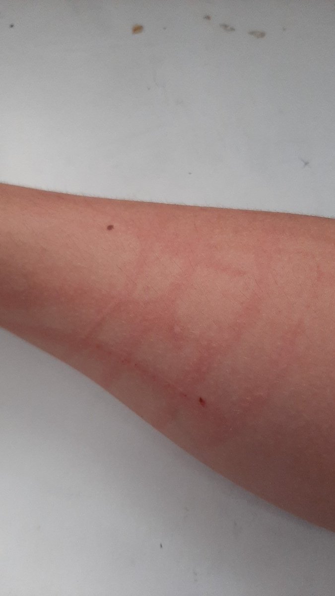 Nexus_Rider09's tweet photo. Dieser Moment wenn man von seiner Schwester angegriffen wird
#narbe https://t.co/fIHBWfCQZ3