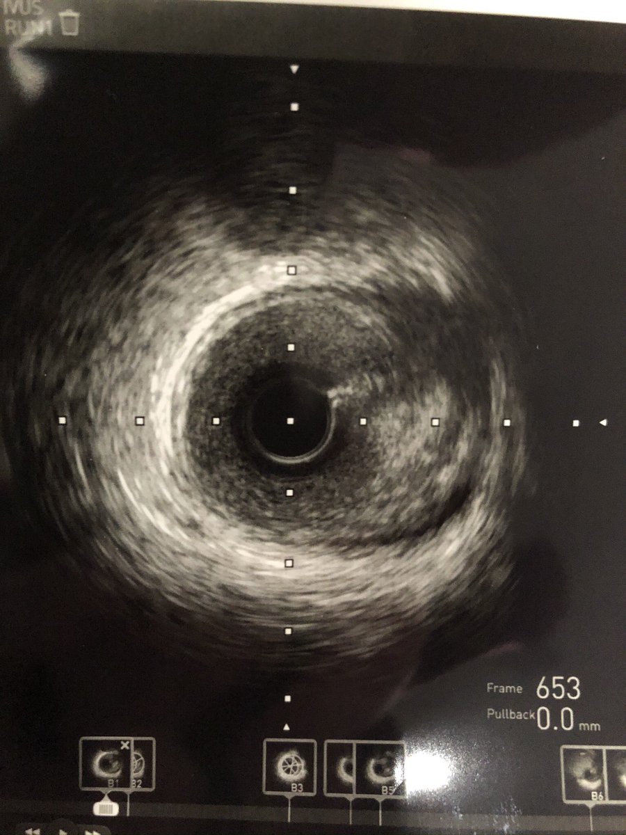 chaddugasmd's tweet photo. 60 y/o male presented with anterior STEMI. My partner took him emergently to Cath and found no obstructive LAD disease. CP persisted so I brought him back later that day and used IVUS. What do you see? https://t.co/TDFMQhfp2a