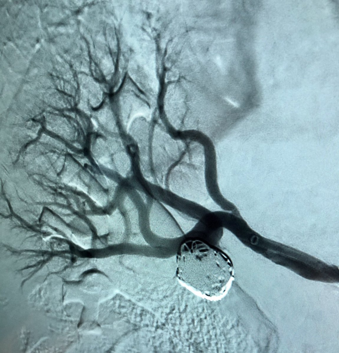 DrDukesVIR's tweet photo. Renal a. aneurysm with anterior (early bifurcation) and posterior outflows. @Stryker_NV NeuroForm balloon for outflow protection & @PenVascular Ruby coils that packed like a champ. No stent nor balloon inflation needed. @aronchary @angiowoman @billmajdalany @DrFLoya @EmoryIRad https://t.co/gCM2UxvHKa