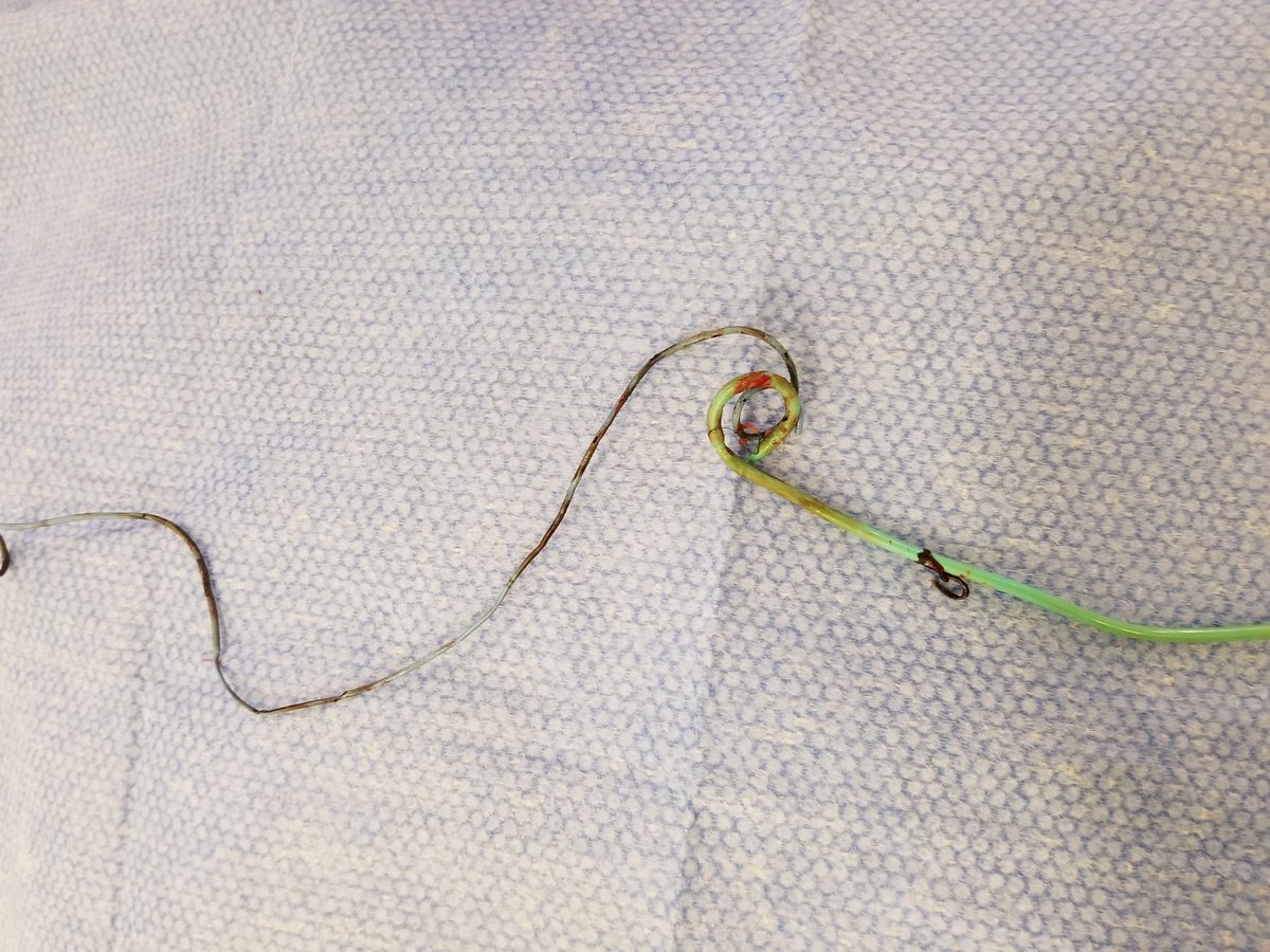 WhatsUpDoc_MD's tweet photo. This morning I helped to remove and replace this nephrostomy tube &amp; ureteral stent.  OSH said that they couldn’t get it to budge.  But this isn’t OSH... #ThisIsOhioState 

@OSURadiology @OhioStateMed @MinaMakaryMD @mmkhayatmd https://t.co/gcIc9wUfeQ