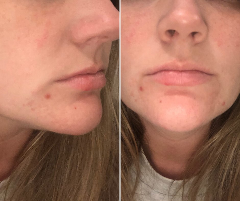 IowaDermatology's tweet photo. Recently, “maskne”--acne occurring on the lower face from wearing a mask has become more common. Fortunately, there are many effective treatment options available.  Make an appointment at Iowa Dermatology Consultants today.   https://t.co/GxiNsZoJMn https://t.co/OURO0Y1N1A
