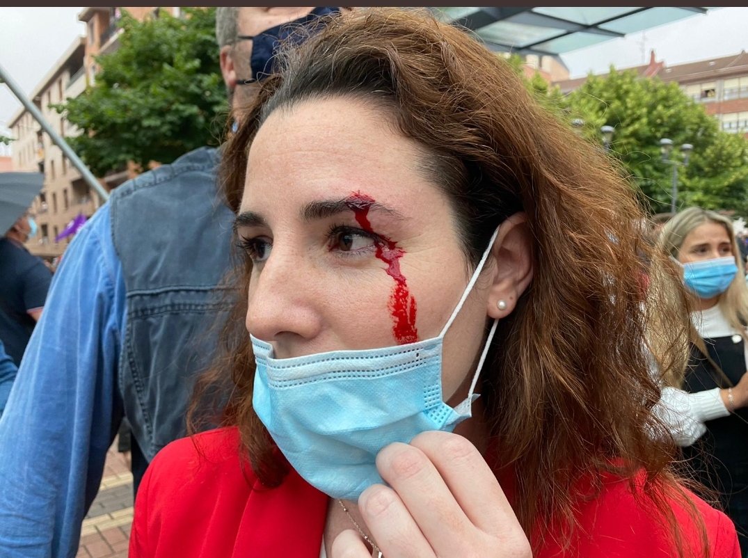 MujerHembraHuma's tweet photo. A la izquierda herida de pedrada en un ojo en persona normal. A la derecha lo mismo en una de vox. Que limpio y que bonito le queda a ella, verdad? https://t.co/haywAx01Lp