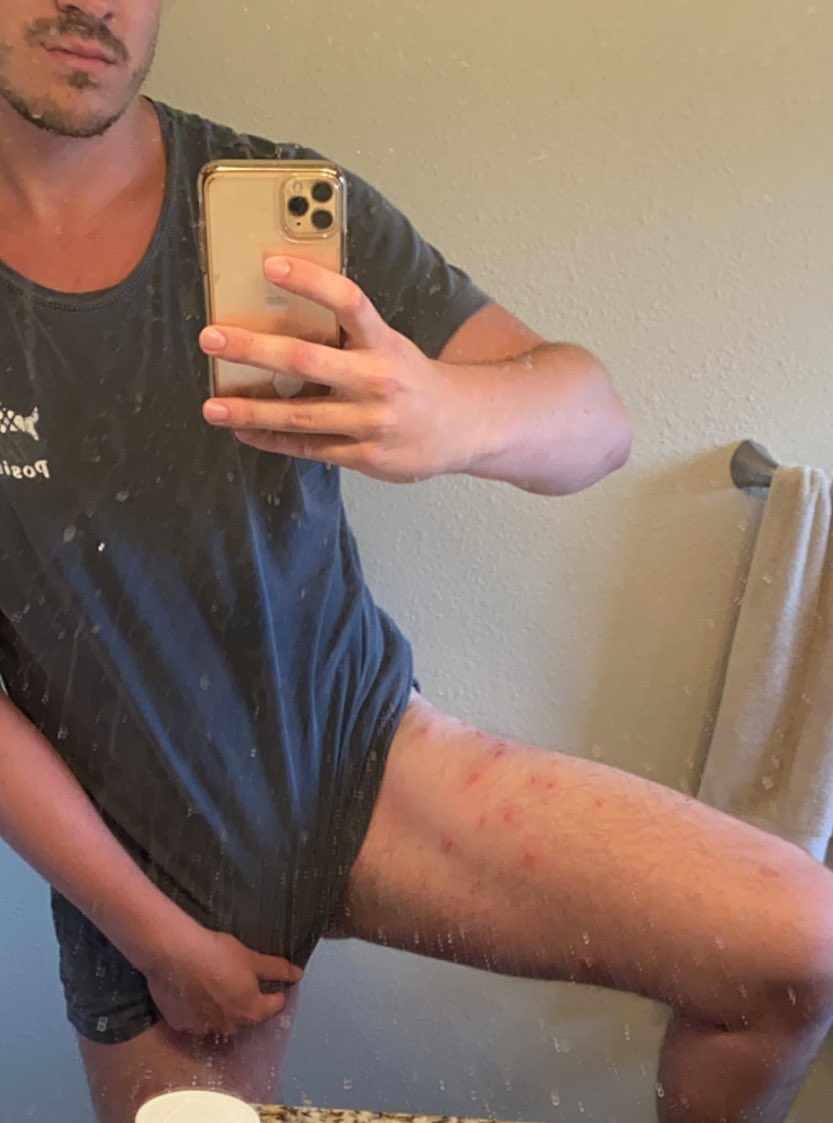ChristiaanA's tweet photo. I know my mirror is dirty as hell but look at these fuckin bug bites 👀👀👀 https://t.co/Ced4Y8eNwt