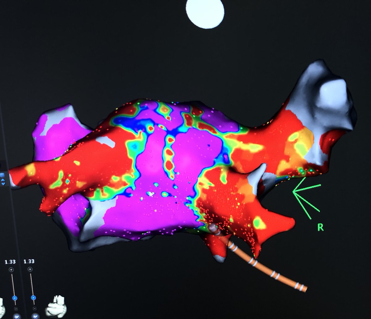 A wonderful X3 case today. LA dwell time was 28 minutes (PVI and pre/post-mapping).  

Just 17 minutes spent to isolate all PVs.

#EPeeps <a href="/dkenigsberg/">David Kenigsberg, MD</a> <a href="/JasonRo18789659/">Jason Rodriguez</a> <a href="/psharmadoc/">Parikshit S Sharma, MD, MPH, FACC, FHRS</a> <a href="/krishmd/">Kousik Krishnan</a> <a href="/DrCarlosMacias/">Carlos Macias, MD</a> <a href="/DrRoderickTung/">Roderick Tung</a> <a href="/JRWinterfield/">Jeffrey Winterfield</a> @brianyunker2 <a href="/CardioFocusAF/">CardioFocus</a> <a href="/RushMedical/">Rush University System for Health</a>