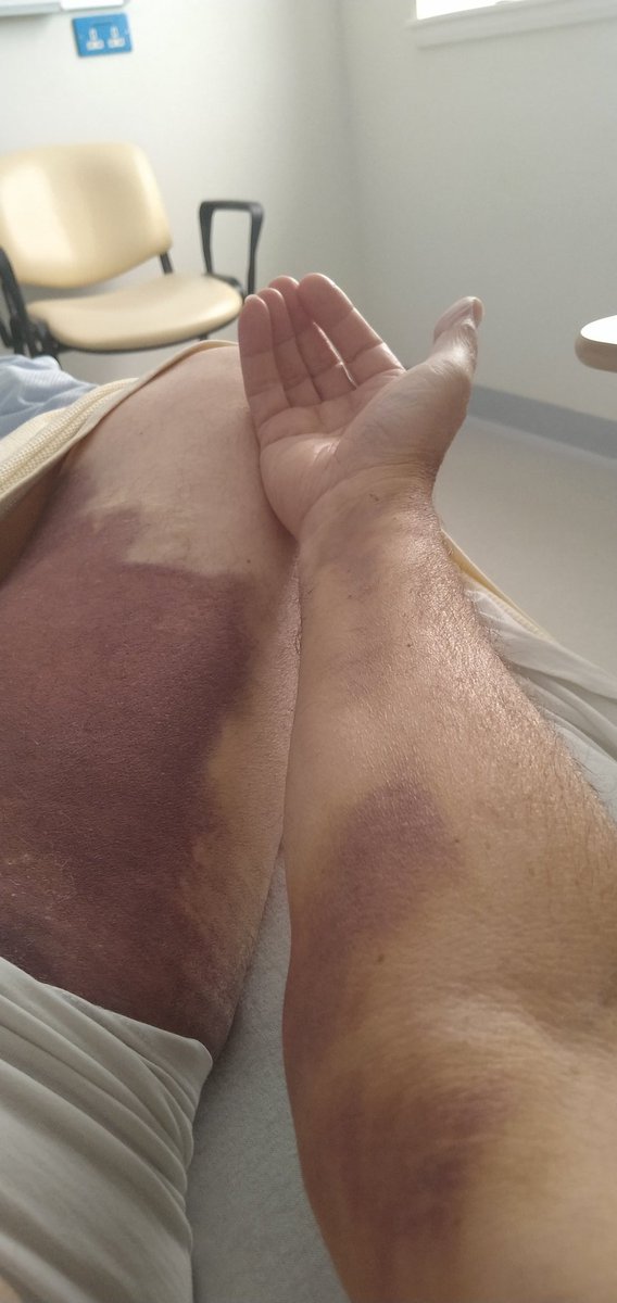 On the road to recovery, no brain damage I think. Tiddlyumpopo.