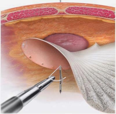 ClinicalSurgery's tweet photo. #Hernia-Roof Access : A Novel #Technique to Enter Preperitoneal Space in Groin #Hernia Repair

Journal of #Surgery &amp; #Clinical Practice https://t.co/gNLMMK4vyA
