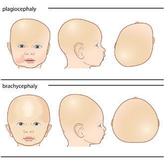 Почему растет голова ребенка. Кривошея плагиоцефалия. Деформация черепа плагиоцефалия.. Краниосиностоз плагиоцефалия. Компенсаторная лобная плагиоцефалия.