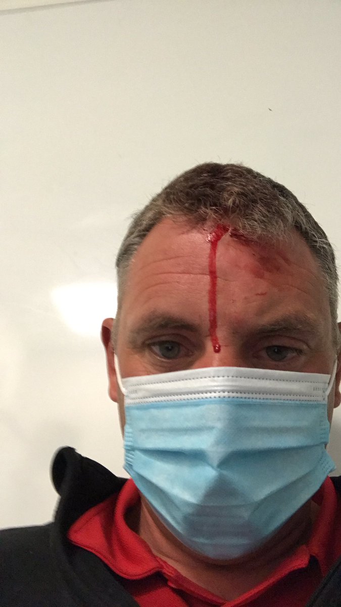 Yesterday I was hit by a stray golf ball! After 2 visits to A&amp;E they stuck me back together. I was lucky. Please take care when working on tour courses! Bump caps ordered!