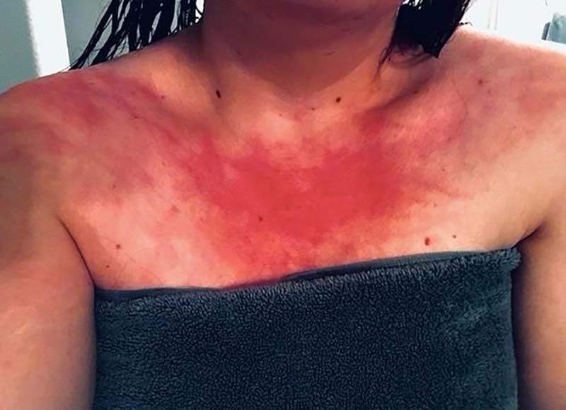 水アレルギー Twitter Search