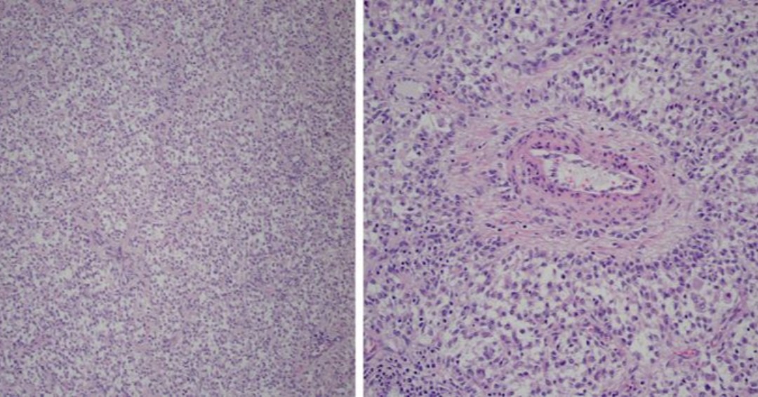 TexPathol's tweet photo. PEComa of uterus – diffuse, nested, or corded growth of epithelioid/spindle cells with prominent vascularity and perivascular radial arrangement of tumor cells. Co-expression of smooth muscle and melanocytic markers on IHC. Associated with TSC1/2, TFE3 mutations. #GYNPath https://t.co/6lEdMmqT6q