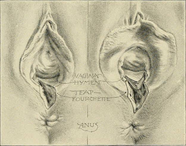 Now what is "NON-OBSTETRIC VAGINAL TEAR" Let's break it down...• NON: Not• OBSTETRIC: Relating to childbirth• VAGINAL TEAR: A tear in a woman's vaginaSo "NON-OBSTETRIC VAGINAL TEAR" is the tear in a woman's vagina not caused by childbirth...Makes sense right???