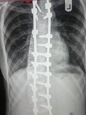 Today is #ScoliosisAwarenessday ! Here's an X-ray of my spine post-op alongside a still from my short film , Anatomy of a Crooked Spine! Watch it here: bbc.co.uk/programmes/m00… (starting around 6 mins in) 
<a href="/NewCreativesN/">New Creatives North</a> <a href="/bbcarts/">BBC Arts</a> @BBCFOUR @ScoliosisUK