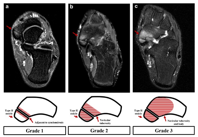 The latest from @JeffersonRads and @SkeletalRadiol : MRI classification of painful type II os naviculare. Read more at: rdcu.be/b43lJ @jeffbelair @AZOGA @morrisonMSK #MSKRad