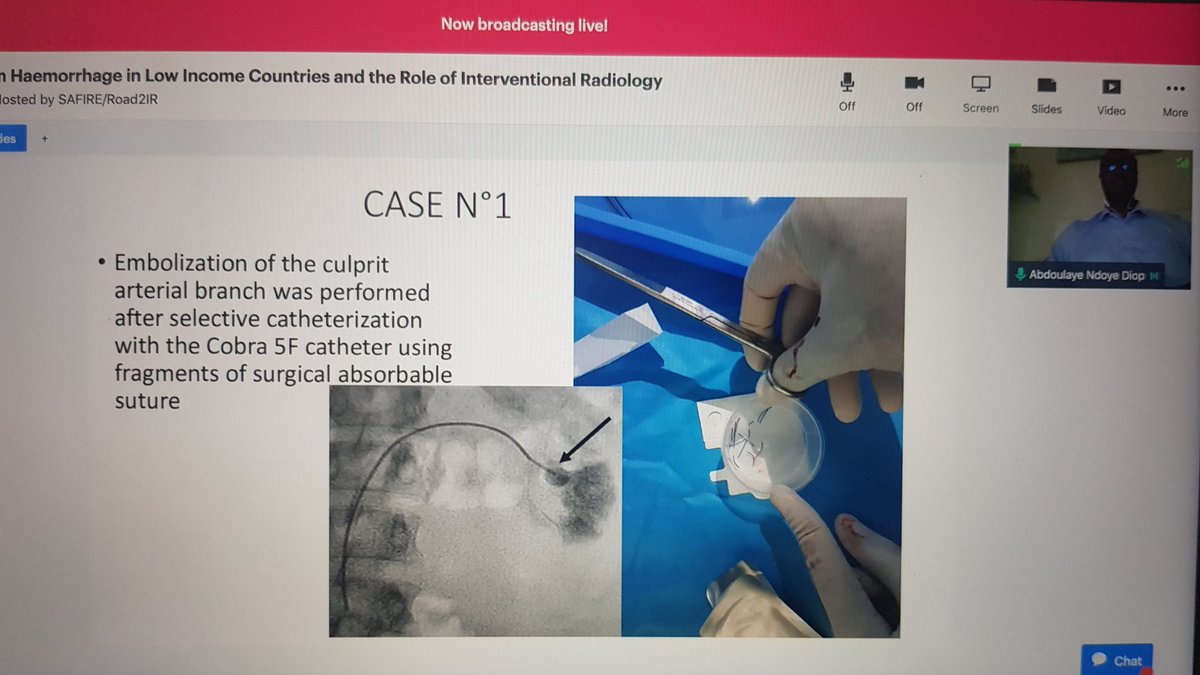 IR thinking outside the box: FAIR-EMBO concept. A game changer for embolisation world wide! @emborrhoid <a href="/Road2IR/">Road2IR</a> <a href="/RADAIDIntl/">RAD-AID</a> @GregMakris23