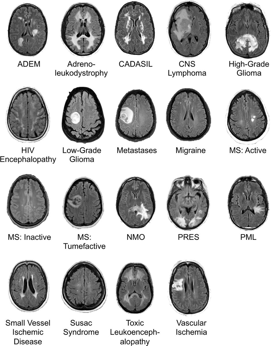 PearlsNeurology's tweet photo. From @The_ASPNR, great image!
https://t.co/KAAtM9wLJF  #neurorad #radiology #neuroradiology #imaging #neurorads #mri #mribrain https://t.co/GzwacO9Yz2