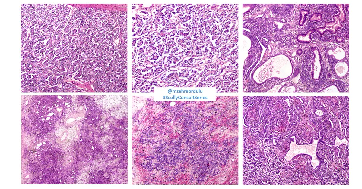 Happy  #SCSSaturday! 18 yo F, virilizing symptoms and 36 cm right ovarian mass.  #ScullyConsultSeries  #GynPath  #GynPathQuiz  #SurgPath  #PathTwitter