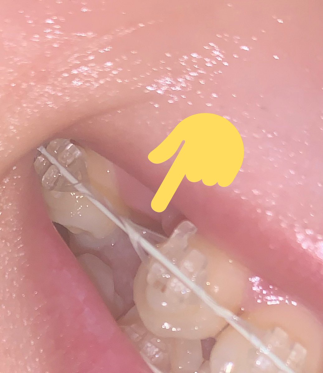 ピンクマイク 出っ歯矯正 On Twitter 歯列矯正4ヶ月目 親知らず抜歯以来の痛みで蒸しパンしか食えない ワイヤーにゴムかかってんな って思ってたけどこれパワーチェーンって言うらしく 歯抜けになってる隙間を埋めるために用いる方法らしい クソ痛いから頑張って