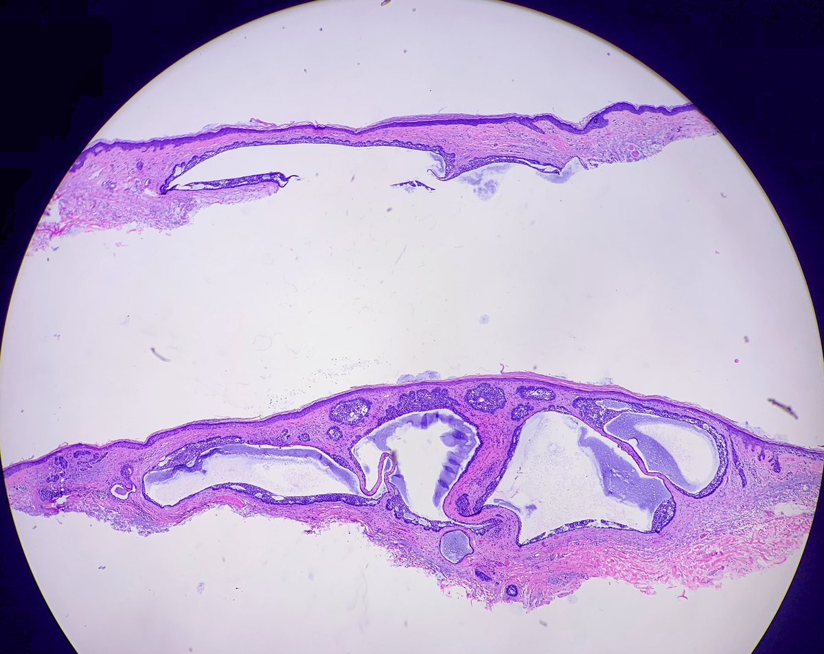 HENRYY_MD's tweet photo. Happy Saturday. Share a few classic easy-peasy #dermpath cases.  For residents. Look at this Cystic BCC! Seems like some mucin in the cyst! @DrAHLAMN1 @vhnguyenmd @haomibb @lanlanxuan @FTTUD4D3cm5uUNX @ZadjaliDr @DrGeeONE @NishaVajpeyi @Pathology3636 @pembeoltulu https://t.co/ELZvkLV2p5