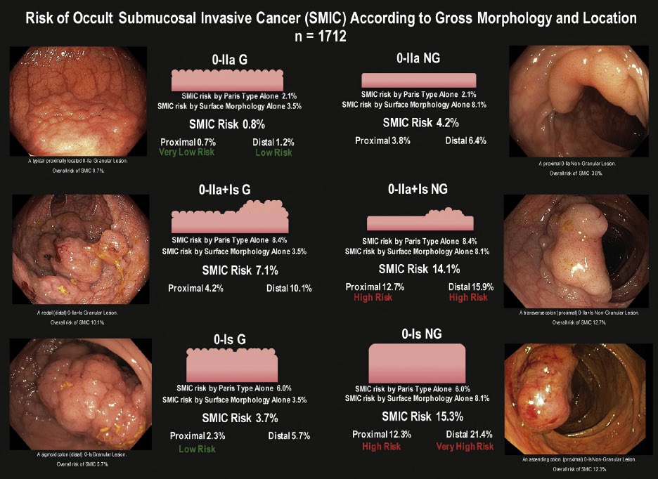RodriguezParra_'s tweet photo. ✅Riesgo de cancer según morfología.

▶️ Burgess NG, Hourigan LF, Zanati SA, et al. Gastroenterology. 2017;153(3): 732-742.e1. https://t.co/QWsfpM3dhH