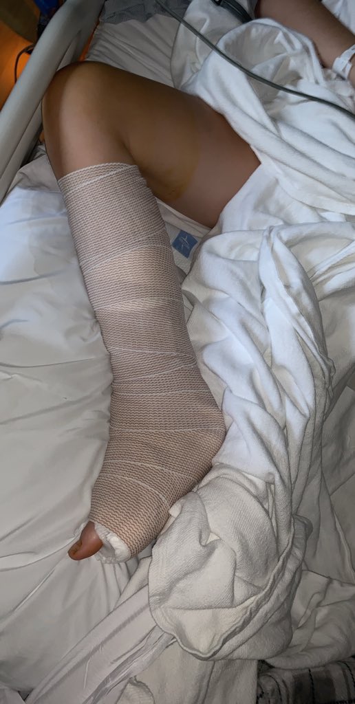 KristynEudes's tweet photo. He expects a full recovery but she will be in the splint for about two weeks until the swelling goes down and then in a cast for around two months. 6/ https://t.co/EBzTE5YTXl