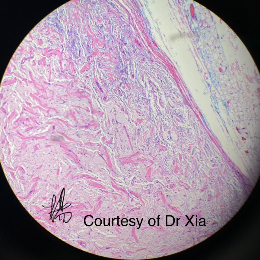 HENRYY_MD's tweet photo. One last case for today. Another can not be more classic: remember the basics? #Dermpath #coolcase Courtesy of my friend Dr Ling Xia. 19 yo boy with lower abdomen lesion. Clinical cyst. @haomibb @andy19801210 @FTTUD4D3cm5uUNX @lanlanxuan @david_terrano @vhnguyenmd @MarcelaSaebL https://t.co/yIQFMs1nfr