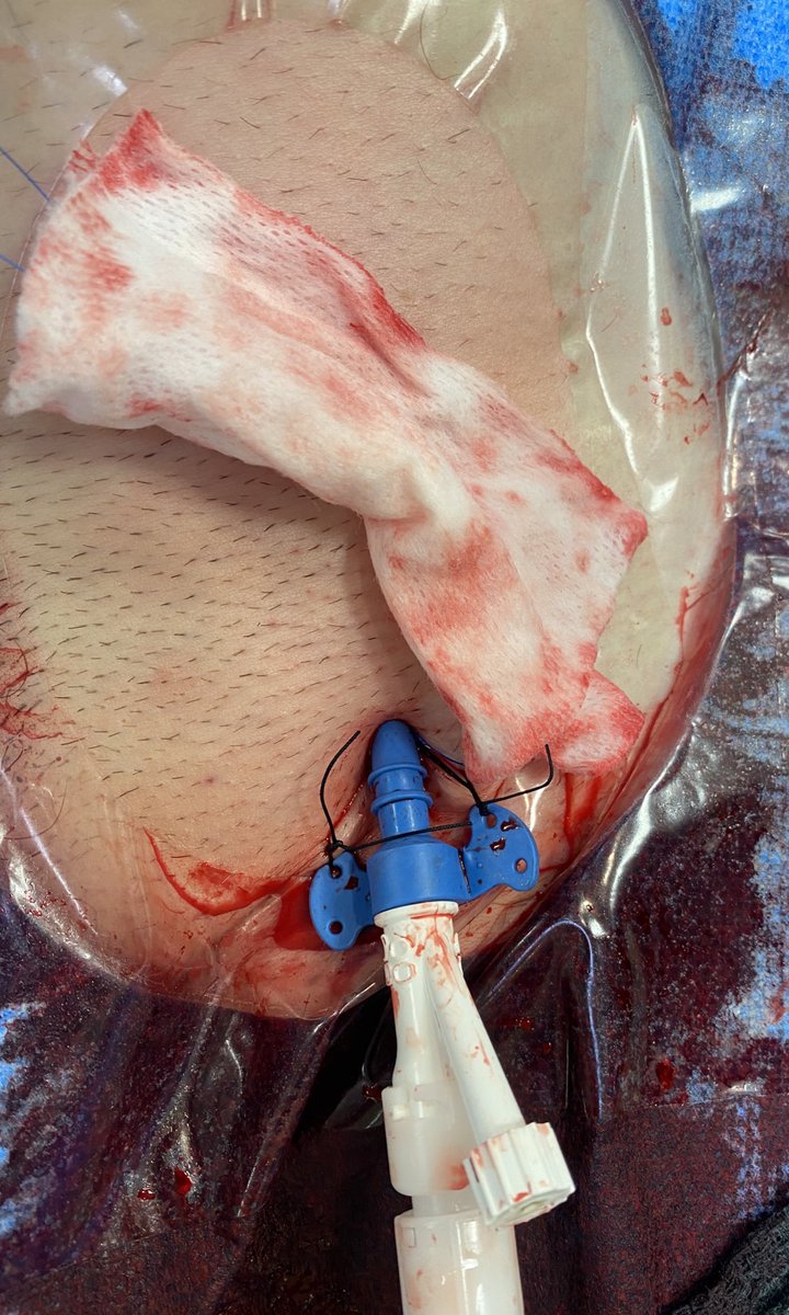 5/7 Remove peel-away sheath. Cinch Perclose around leave-in sheath. Suture sheath in at appropriate angle (after shallow initial access [cantalever principle a la  @J_M_McCabe]) and with sutures placed cranially to preserve forward sheath momentum...