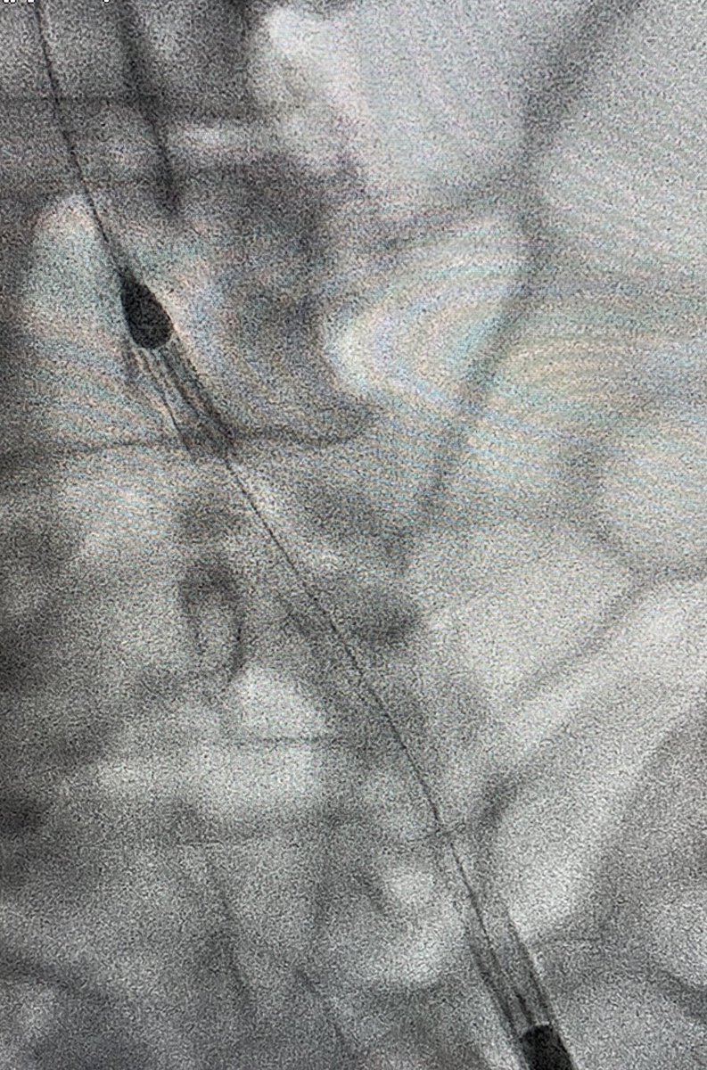 3/7 Impella observed going in. Take a moment to remove slack, achieve stable device position. Always place Swan with Impella in Shock...