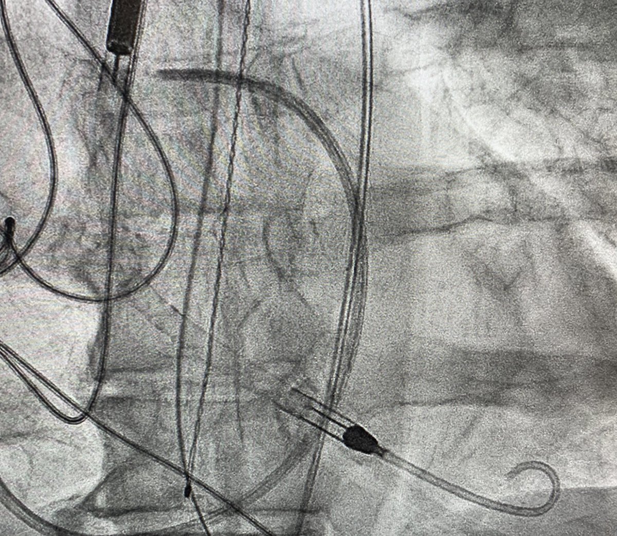3/7 Impella observed going in. Take a moment to remove slack, achieve stable device position. Always place Swan with Impella in Shock...