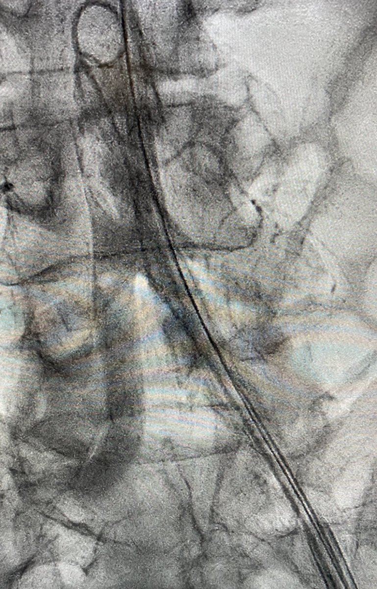4/7 Quick single-access (a la  @jason_wollmuth et al) run-off angiogram at the very end confirming distal flow before removing peel-away sheath (or can perform via Radial access) to assess need for antegrade perfusion catheter...