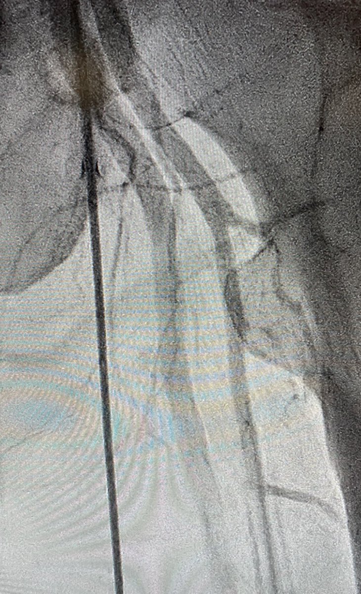 4/7 Quick single-access (a la  @jason_wollmuth et al) run-off angiogram at the very end confirming distal flow before removing peel-away sheath (or can perform via Radial access) to assess need for antegrade perfusion catheter...