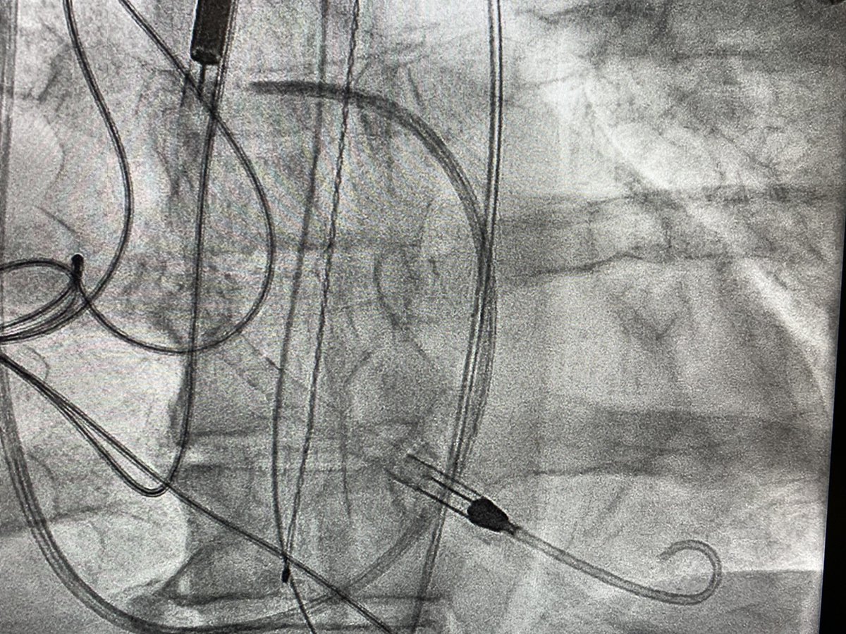 6/7 Place dressings. Reassess Hemodynamics (check response to device: especially effect on RV, need for escalation). Recheck device position/remove slack. Place A-Line. Only then up to CICU....