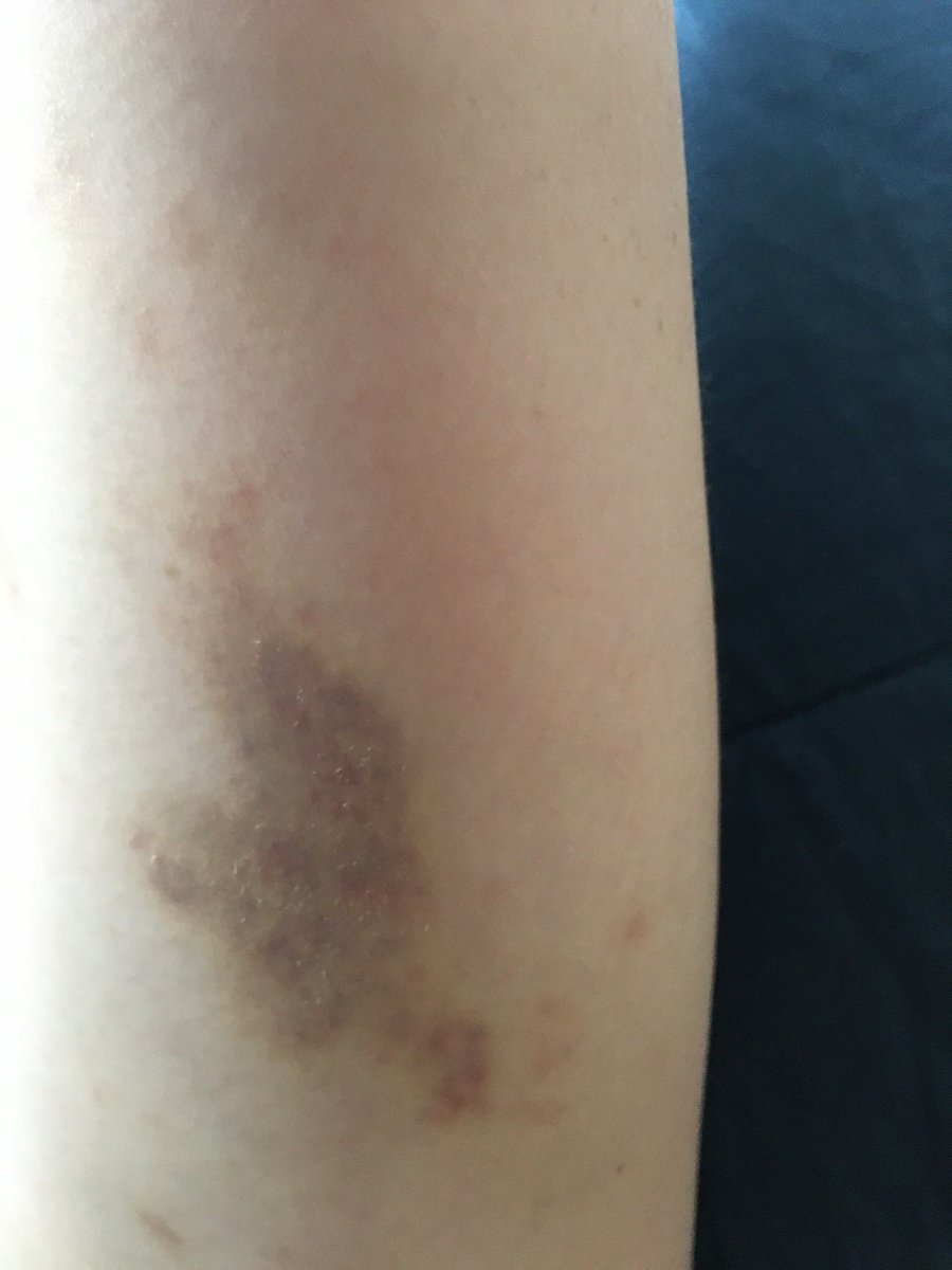 baggerboom's tweet photo. (8/x) Und schließlich hier noch die Dokumentation der Folgen dieses völlig unangemessenen Verhaltens der Polizei: https://t.co/VLfI1Ms3t6