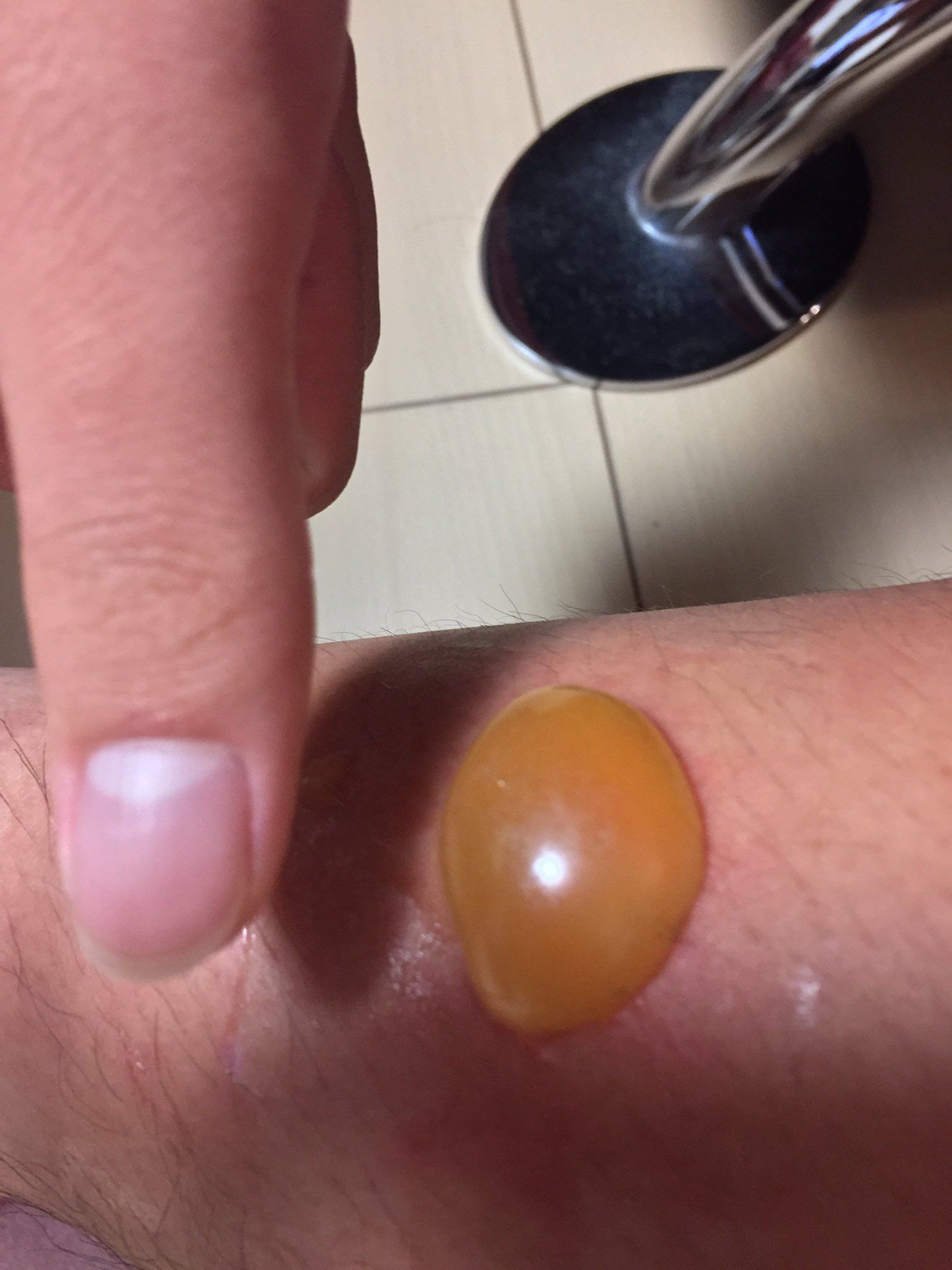 永遠 炎兄 虫刺され 水膨れ 弟が虫に刺されると毎年こんな水膨れ状態になります これ原因は何 アレルギーとか関係してるのかな T Co Tb1u0homsf Twitter