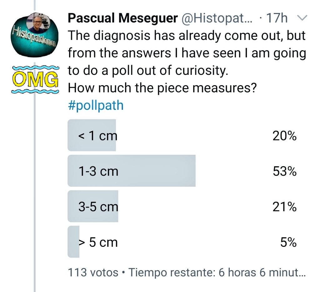 Histopatolomon's tweet photo. As I see that you cannot wait, I will give you the answer. It is a lymph node that measures <1 cm. Now I guess everyone will vote for that. #macromicropath #macromicro #macromicrocorrelation #lymphnode #hiperrealismo #hyperrealism https://t.co/LrGyRaIwla
