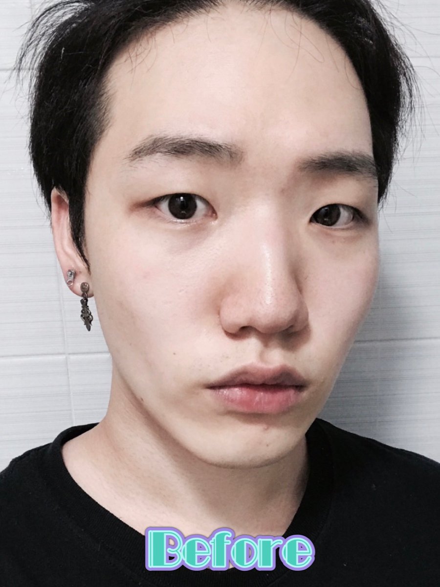 韓国美容観光エージェンシーharu Da美容外科 の 男性整形 目と鼻の整形でカッコよくも可愛い イケメン男子誕生 手術内容 非切開目つき矯正 目尻切開 わし鼻矯正 ご質問 お問い合わせはlineへ T Co Lhidcwcvdc Haruブログ
